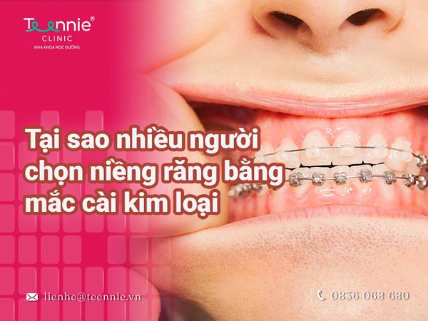 Sử dụng mắc cài kim loại trong niềng răng tại nha khoa giá bao nhiêu?