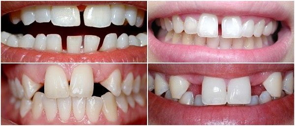 Răng thưa là tình trạng răng hàm không đủ hoặc các răng trên hàm đứng cách xa nhau