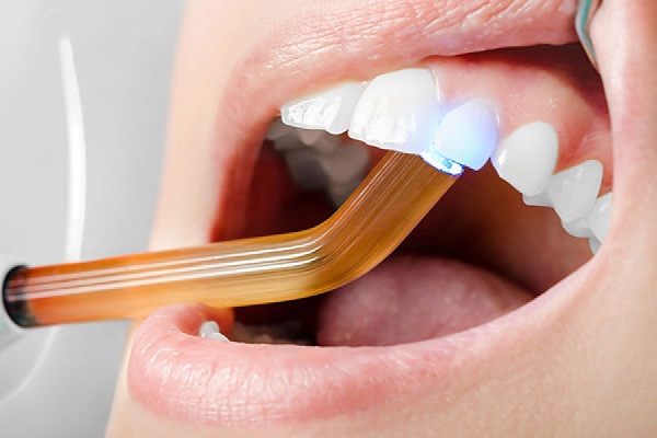 Trám răng thưa là phương pháp cải thiện phổ biến
