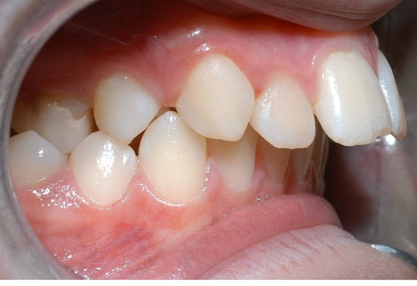 Răng vẩu là gì? Nguyên nhân và các dạng răng vẩu thường gặp
