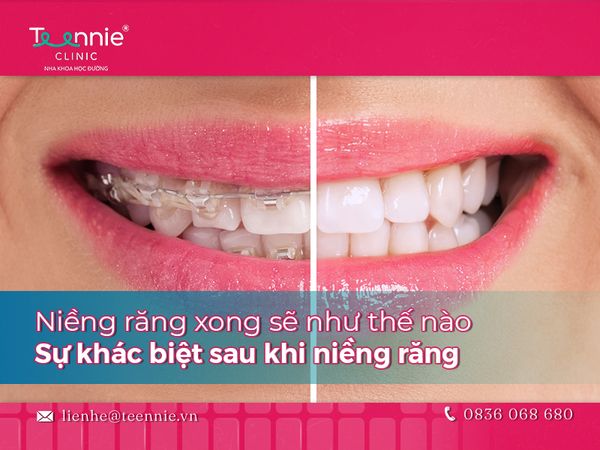 Niềng răng xong sẽ như thế nào – Sự khác biệt sau khi niềng răng