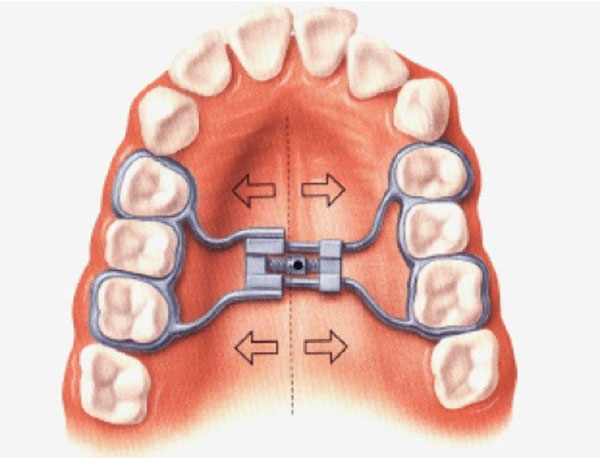 Nong hàm khi niềng răng được bác sĩ chỉ định thực hiện với mục đích giúp nới rộng diện tích vòm miệng và tăng khoảng cách giữa các răng