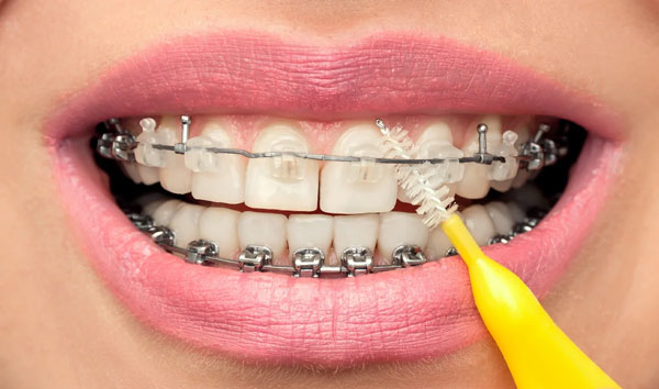 Nong hàm khi niềng răng cần lưu ý những gì?