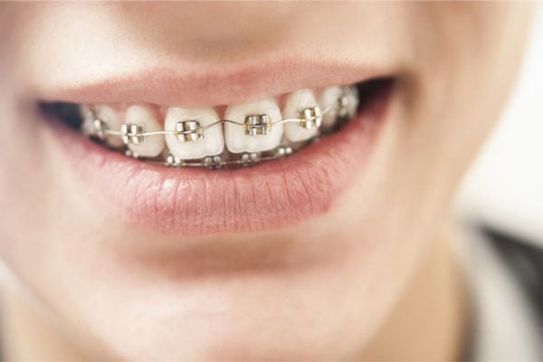Niềng răng giúp khắc phục các tình trạng răng hô, móm, thưa, răng mọc sai lệch, khớp cắn không chuẩn,...