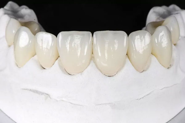 Phục hình răng bằng phương pháp bọc răng sứ cho nụ cười đẹp tự nhiên