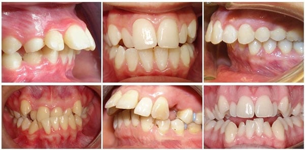 Những dấu hiệu nhận biết hàm răng xấu