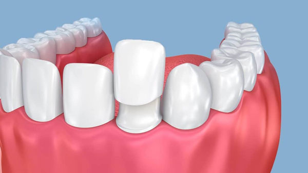 Bọc răng sứ chỉ thích hợp với những hàm răng xấu, bị hô, móm, thưa, lệch lạc nhẹ