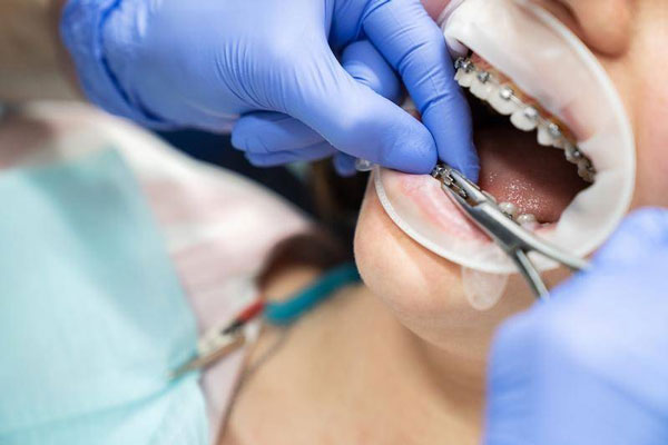 Nguyên nhân đầu tiên dẫn đến tình trạng chạy răng sau khi niềng là do tay nghề bác sĩ