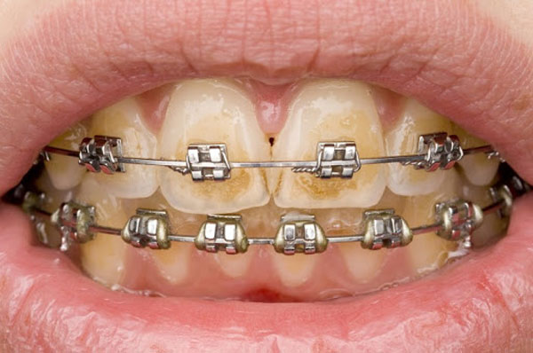Răng bị vàng khi niềng là tình trạng thường gặp khi niềng răng