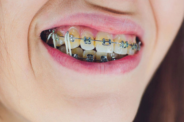 Răng bị vàng khi niềng có nên tẩy trắng?