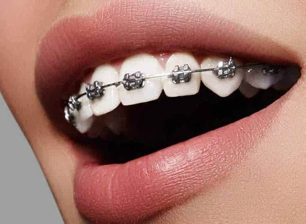 Niềng răng bằng cách sử dụng những khí cụ chuyên dụng giúp điều chỉnh các khuyết điểm răng