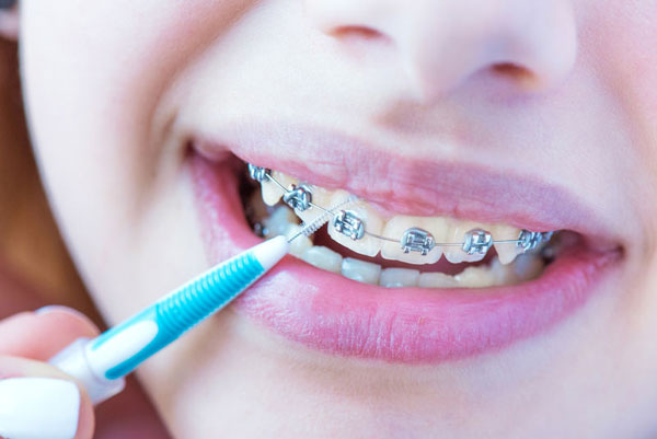 Sử dụng bàn chải chuyên dụng và chải răng đúng cách khi niềng răng