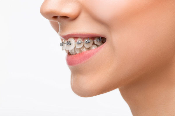 Niềng răng là phương pháp cải thiện răng hô được các bác sĩ nha khoa đánh giá cao nhất hiện nay