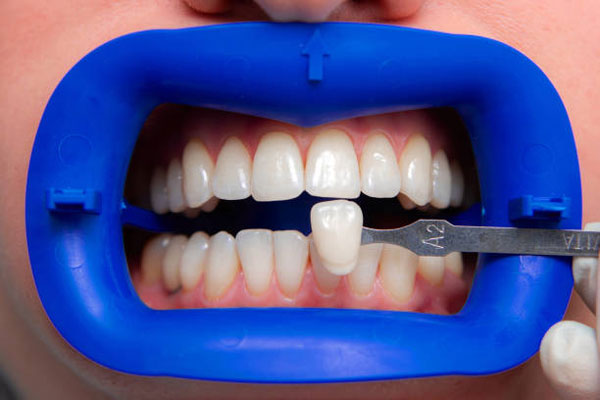 Bọc răng sứ giúp điều chỉnh hình dáng, kích thước, chức năng của răng