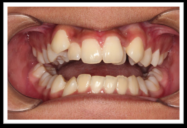 Những ảnh hưởng xấu của răng khểnh