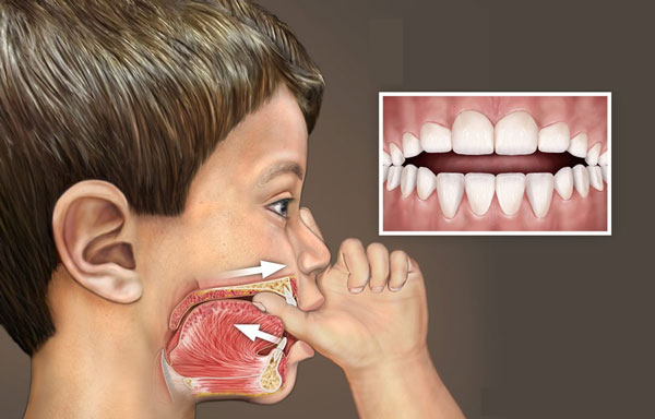 Các thói quen xấu như: Mút tay, mút môi, nghiến răng, chống cằm,... cũng dễ dẫn đến tình trạng răng mọc lệch