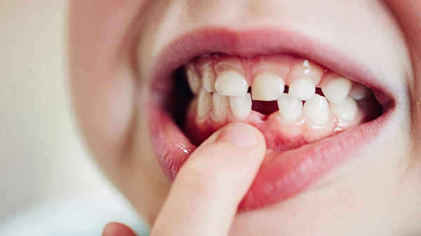 Răng mọc lệch do vĩnh viễn mọc lên có kích thước quá to hoặc quá nhỏ so với khung xương hàm