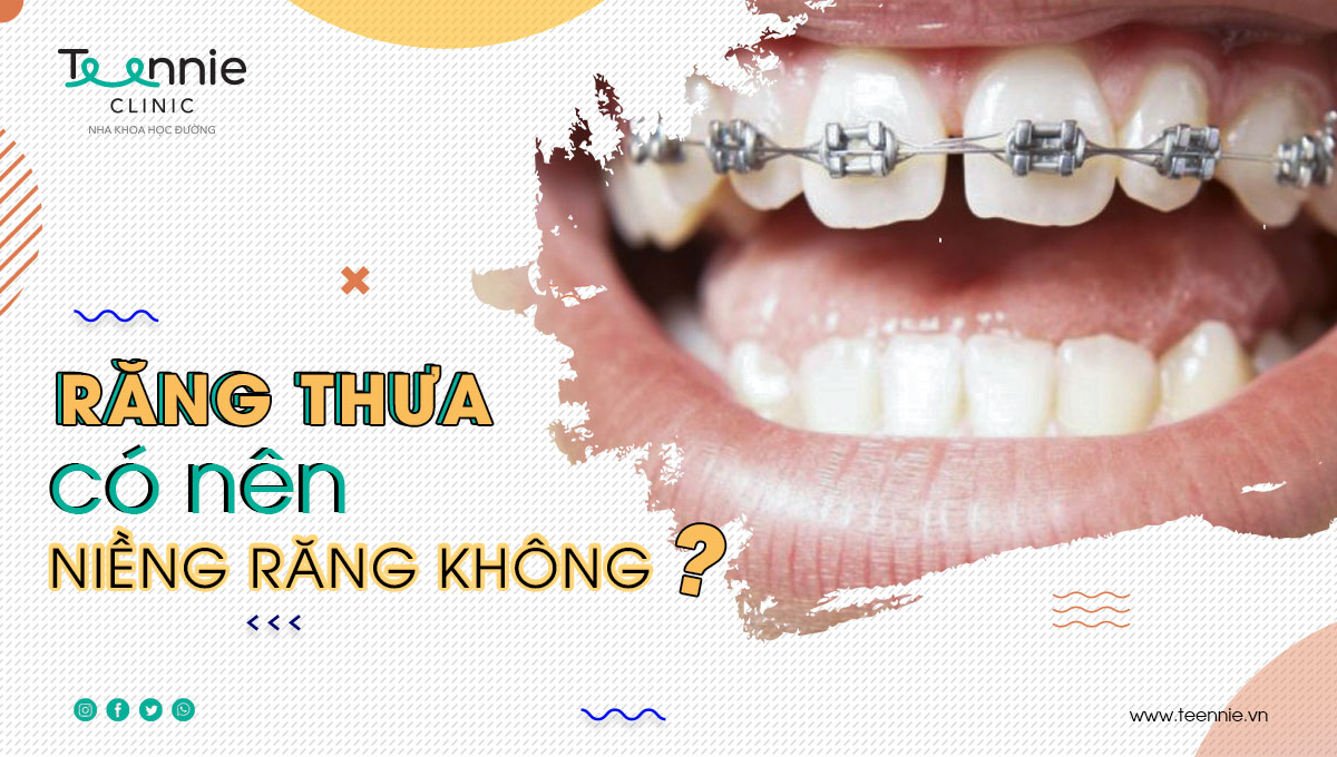 Phương pháp niềng răng thẩm mỹ có khắc phục được tình trạng răng thưa