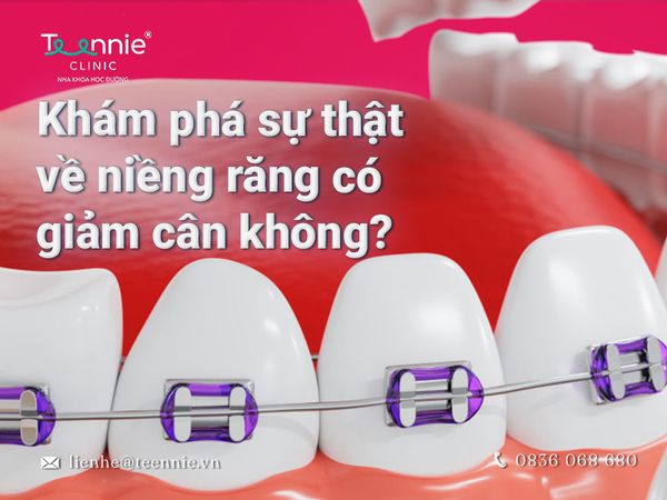 Khám phá sự thật về niềng răng có giảm cân không?