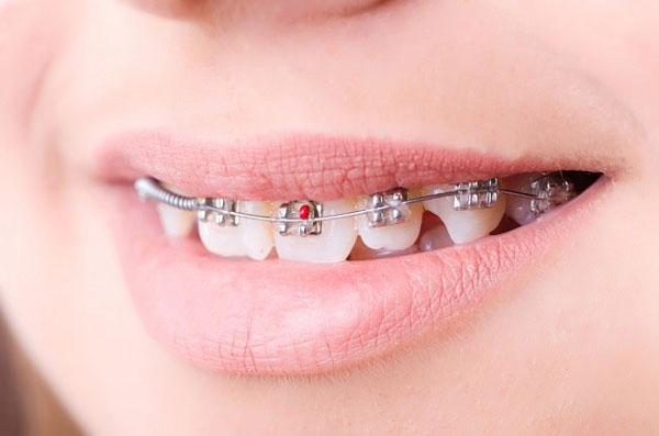 Niềng răng là phương pháp chỉnh nha hiện đại giúp cải thiện tính thẩm mỹ lẫn chức năng ăn nhai cho hàm răng