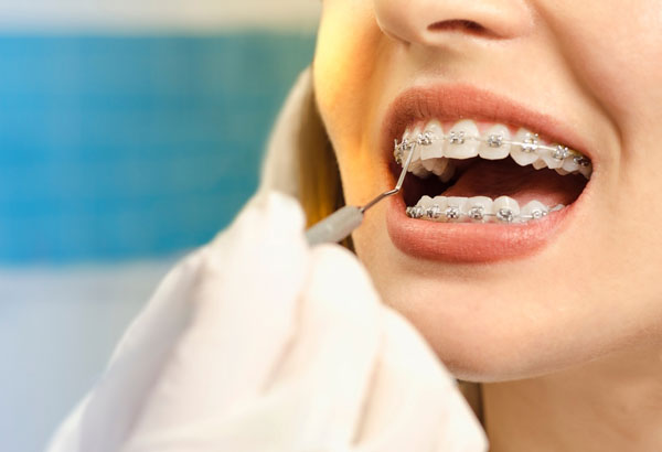 Niềng răng mắc cài kim loại là phương pháp được ưa chuộng nhất hiện nay