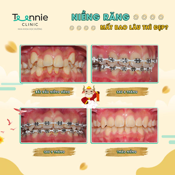 Quá trình niềng răng được tính từ lúc gắn các khí cụ cho đến khi tháo ra và thường có 4 giai đoạn