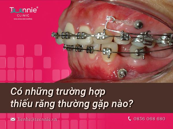 Nha Khoa Teennie giải đáp thắc mắc khi bị thiếu răng có niềng được không?