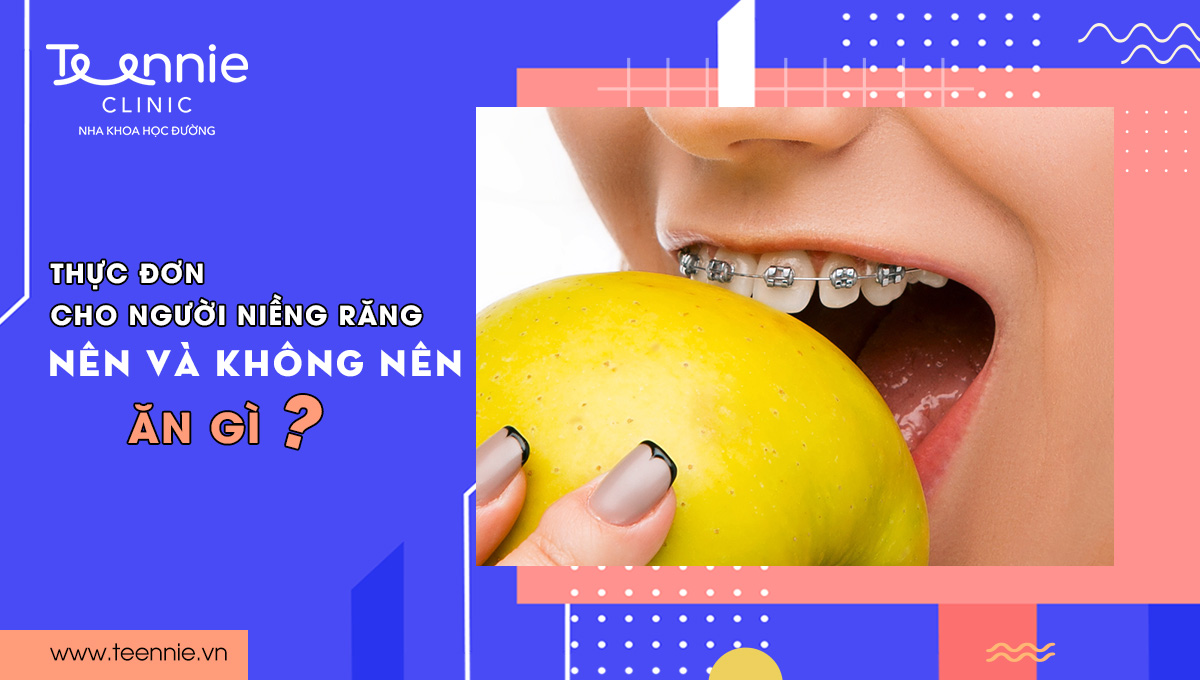 Thực đơn cho người niềng răng: Nên và không nên ăn gì?