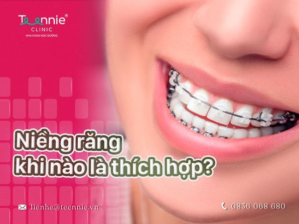 Trám răng có niềng được không – Những lưu ý khi niềng răng cho răng trám
