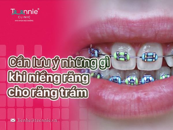 Trám răng có niềng được không – Những lưu ý khi niềng răng cho răng trám