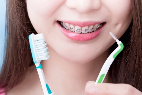 Cần phải đặc biệt chú ý đến khâu vệ sinh răng miệng khi niềng răng và thực hiện đúng cách