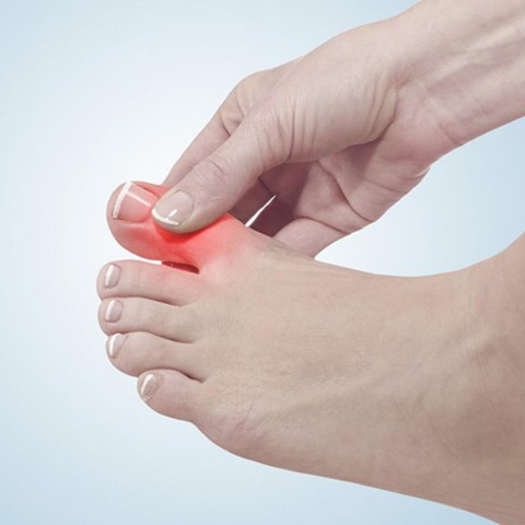 Những điều cần biết về bệnh Gout