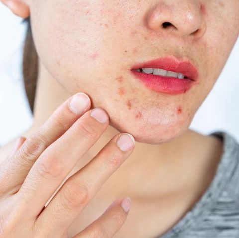 Bí quyết trị mụn ở cằm: Hiểu rõ nguyên nhân để trị dứt điểm