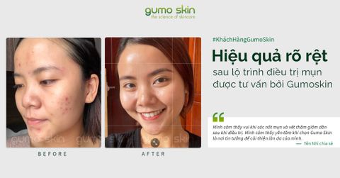 Cải Thiện Mụn, Trị Thâm Sau 2 Tháng Với Bác Sĩ Da Liễu. Bí Quyết Là Gì?