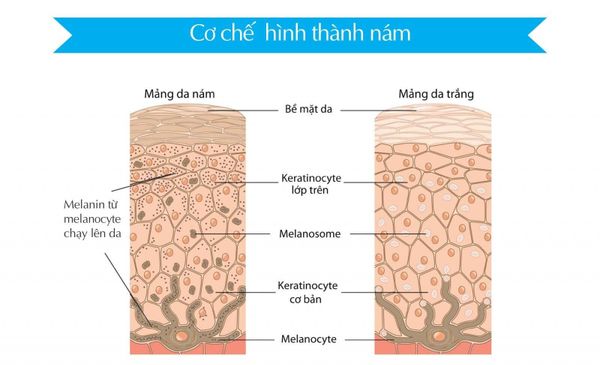 Cơ chế hình thành nám da