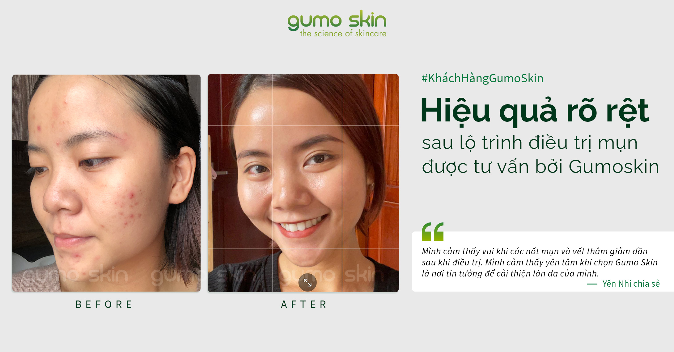 CẢI THIỆN MỤN, TRỊ THÂM SAU 2 THÁNG VỚI BÁC SĨ DA LIỄU. BÍ QUYẾT LÀ GÌ?