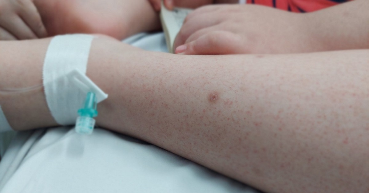 7 quan điểm sai lầm về sốt xuất huyết mẹ cần loại bỏ