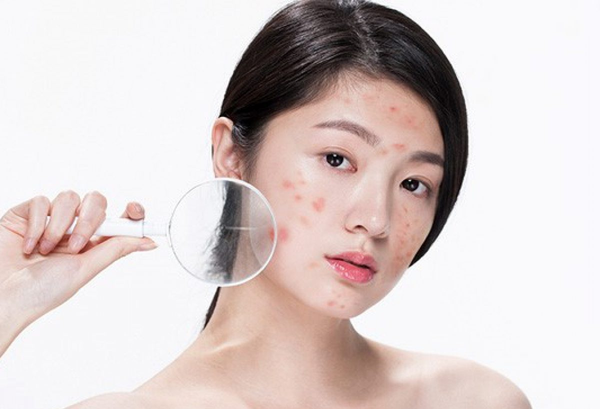 Cách skincare dưỡng da mụn tuổi dậy thì