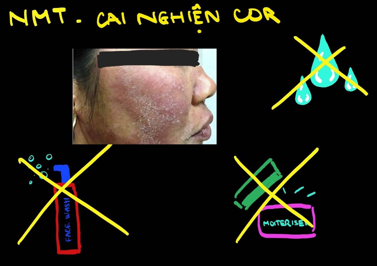 NMT (No moisture treatment) - Cai Cor bạo liệt - một chiếc chia sẻ