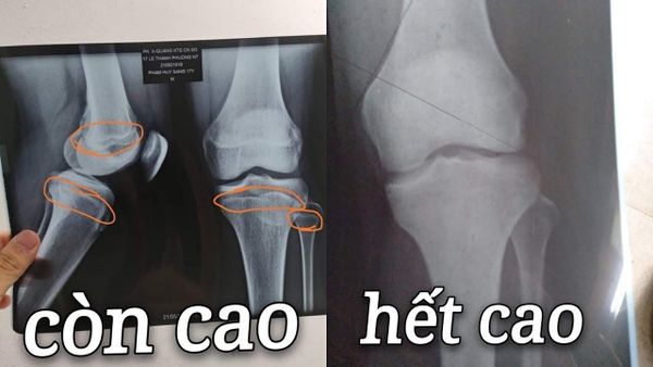 Cách nhận biết mình còn cao được không?