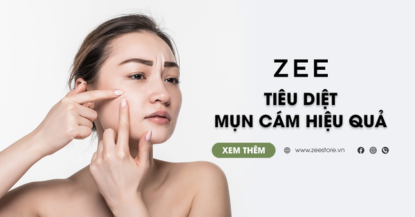 7 Tuyệt Chiêu Đơn Giản Giúp Tiêu Diệt Mụn Cám Hiệu Quả