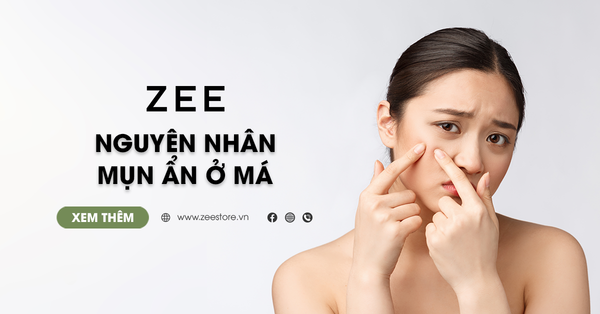 6 Nguyên Nhân Dẫn Đến Mụn Ẩn Ở Má Và Cách Điều Trị