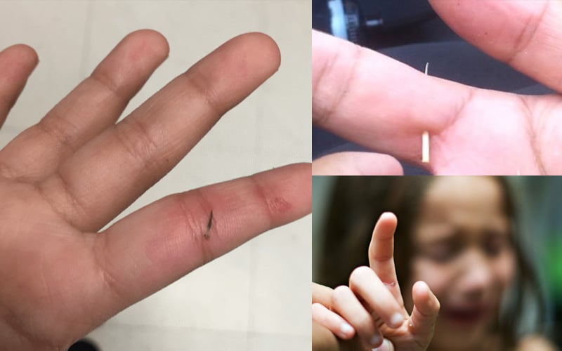 Mách Bạn Mẹo Lấy Dằm Nhanh Chóng, Hiệu Quả Và Không Đau Nhức