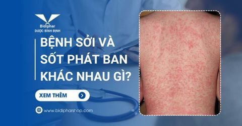 Bệnh Sởi Và Sốt Phát Ban Khác Nhau Gì? Phân Biệt Ngay