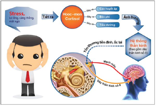 Căng thẳng, stress là một trong những nguyên nhân gây bệnh rối loạn tiền đình