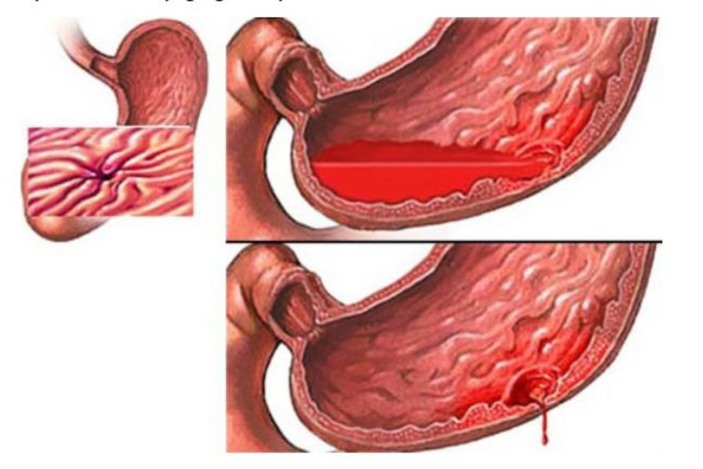 xuất huyết tiêu hóa