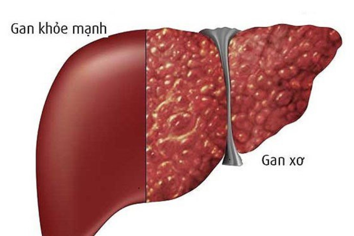 Uống nhiều rượu bia dẫn đến xơ gan