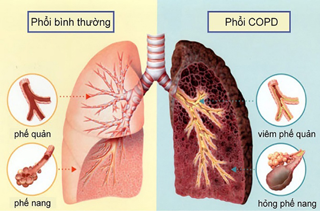 Bệnh phổi tắc nghẽn mạn tính - COPD có nguy hiểm không?