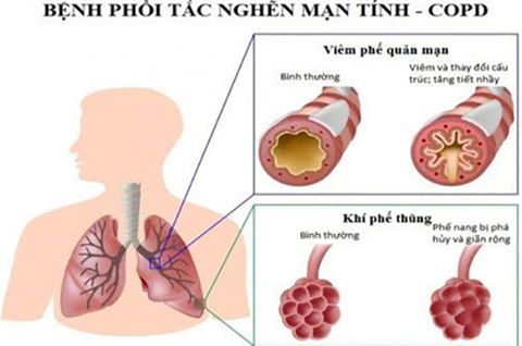 Đẩy lùi phổi tắc nghẽn mãn tính - COPD bằng phương pháp y học cổ truyền
