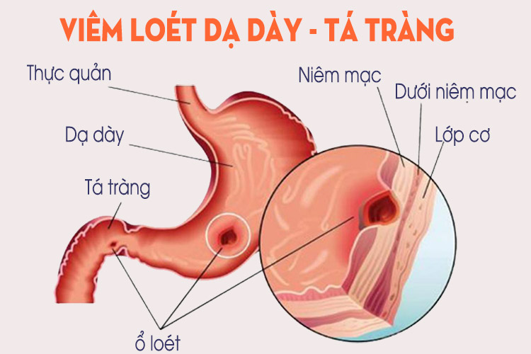 Điều trị viêm loét dạ dày - tá tràng bằng bài thuốc đơn giản